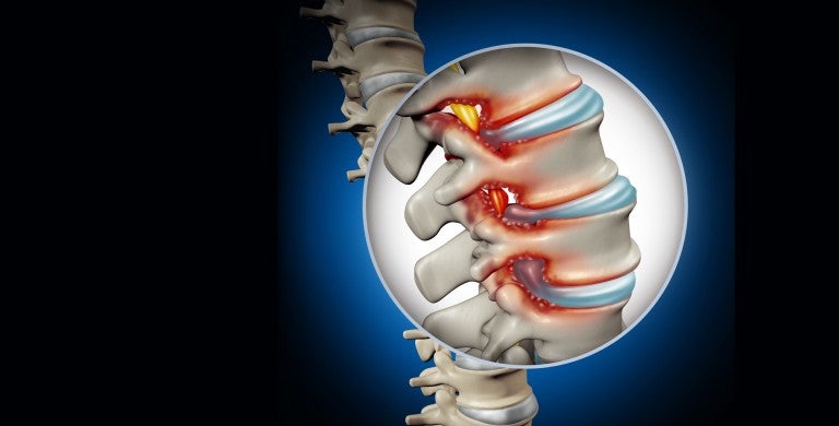Spinal Stenosis Surgery Lehigh Valley Health Network 